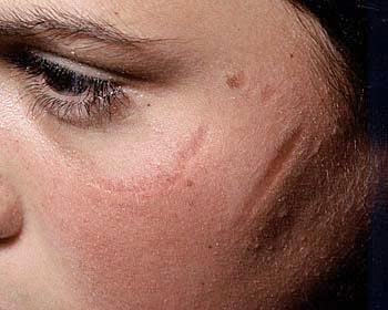 Facial Scarring Photograph View 1