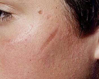 Facial Scarring Photograph View 2